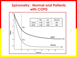 Hô hấp ký của bệnh nhân COPD