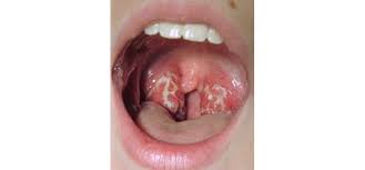 Viêm họng do vi khuẩn Streptococcus