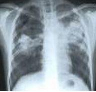 X-quang phổi tổn thương đối xứng hai bên