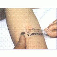 Test nhiễm lao bằng Tuberculin