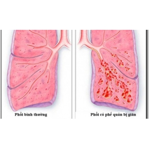 Bronchiectasis