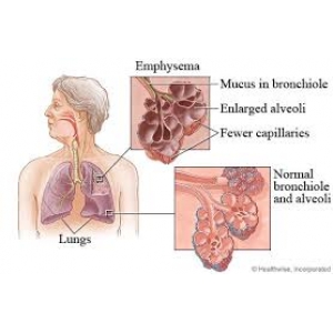 Systemic effects of COPD