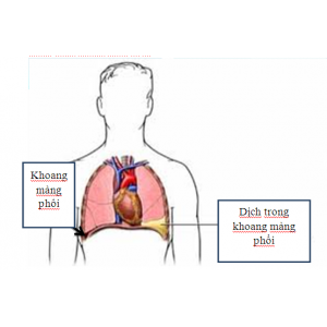 Nguyên nhân thường gặp của tràn dịch màng phổi