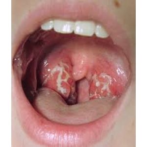 Viêm họng do liên cầu khuẩn (Streptoccocus)