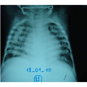 Primary tuberculosis